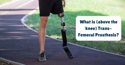 What is (above the knee) Trans-Femoral Prosthesis?